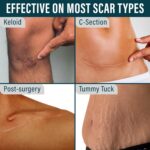 NUVADERMIS Silicone Scar Sheets for Surgical Scars - 120" x 1.5" Roll - Medical ... - Image 6