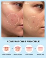 LitBear Acne Pimple Patches- Day and Night 4 Sizes 180 Dots Thin & Thick Hydroco... - Image 7
